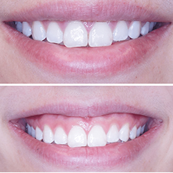 Lip Respositioning Surgery